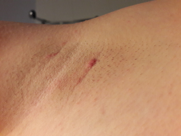 Was Sind Das Fur Kleine Knubbel Unter Meiner Achsel Gesundheit Medizin Jungs Was Sind Das Fur Kleine Knubbel Unter Meiner Achsel Gesundheit Medizin Jungs