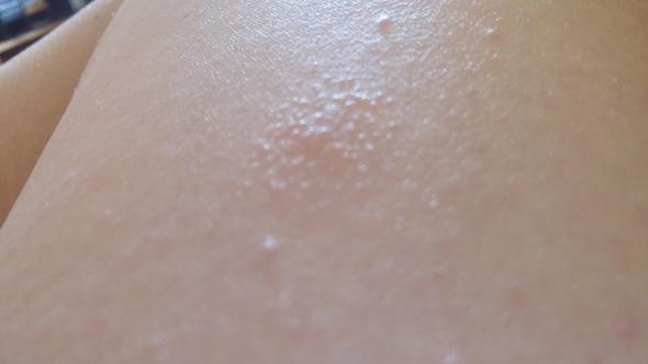 Was Sind Das Fur Kleine Blasen Auf Meiner Haut Kommt Das Von Der Sonne Gesundheit Was Sind Das Fur Kleine Blasen Auf Meiner Haut Kommt Das Von Der Sonne Gesundheit