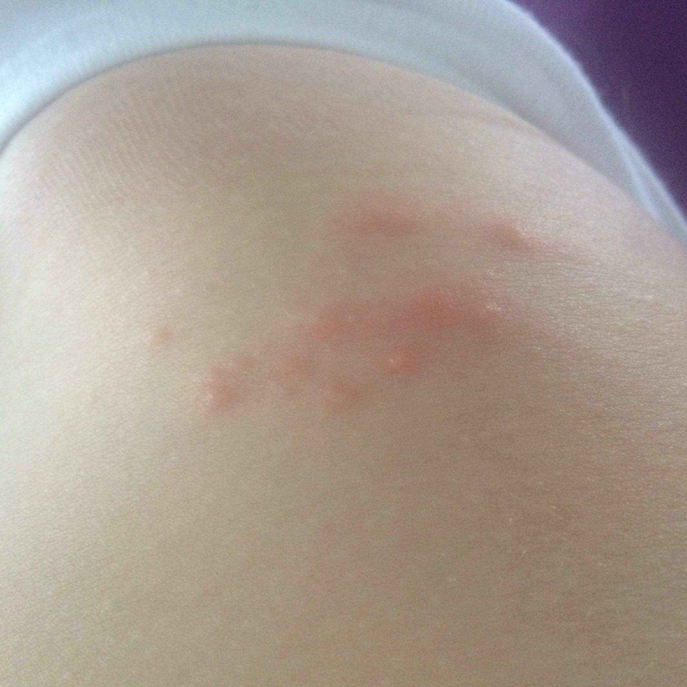 Was sind das für kleine pickelchen an meiner Hüfte? (Pickel, brennen