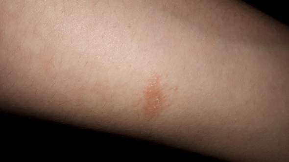 Was Sind Das Fur Kleine Rote Flecken An Meinem Korper Gesundheit Und Medizin Medizin Krankheit Was Sind Das Fur Kleine Rote Flecken An Meinem Korper Gesundheit Und Medizin Medizin Krankheit