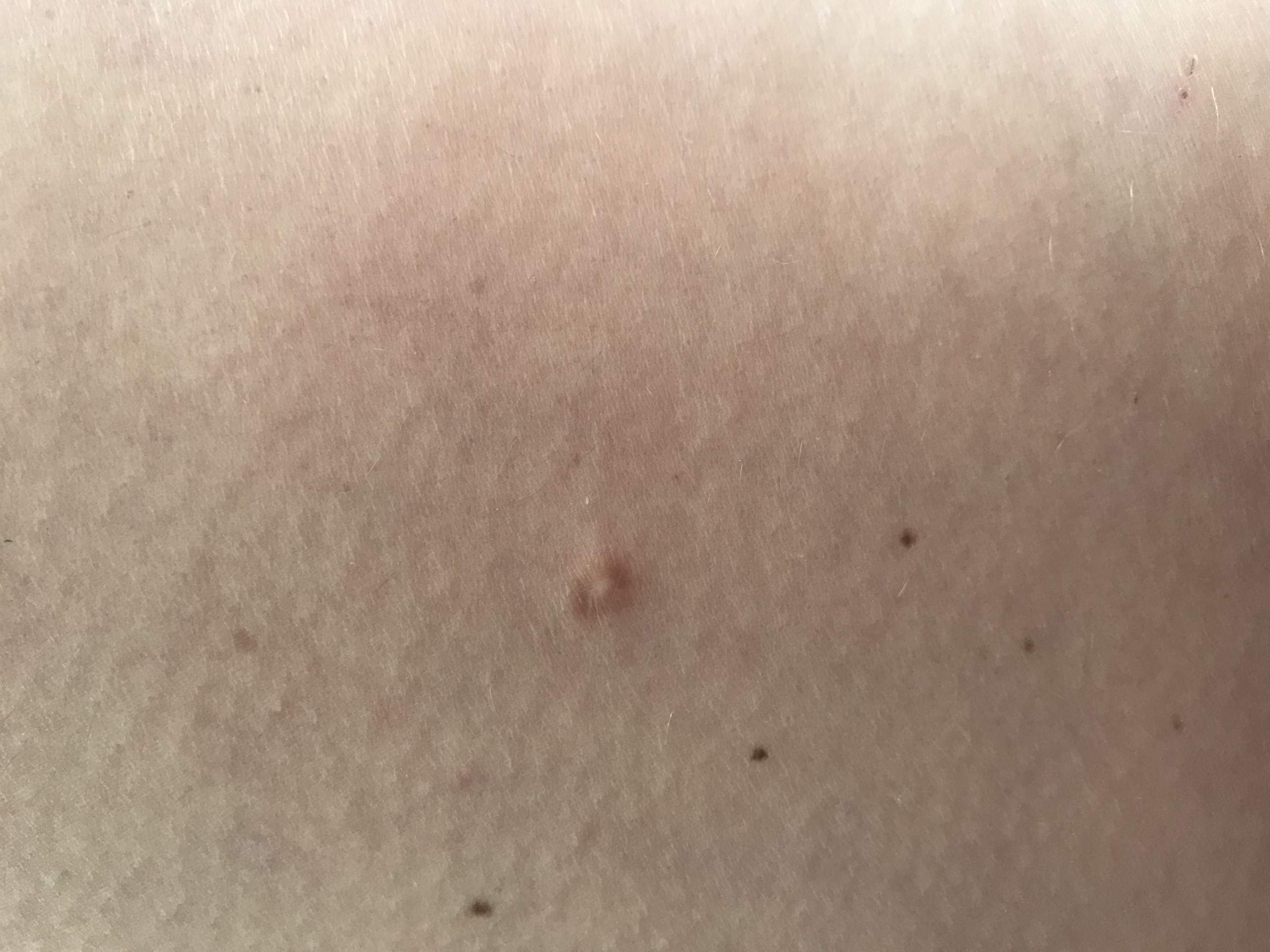 Was sind das für Knoten an meinem Oberschenkel? (Gesundheit)