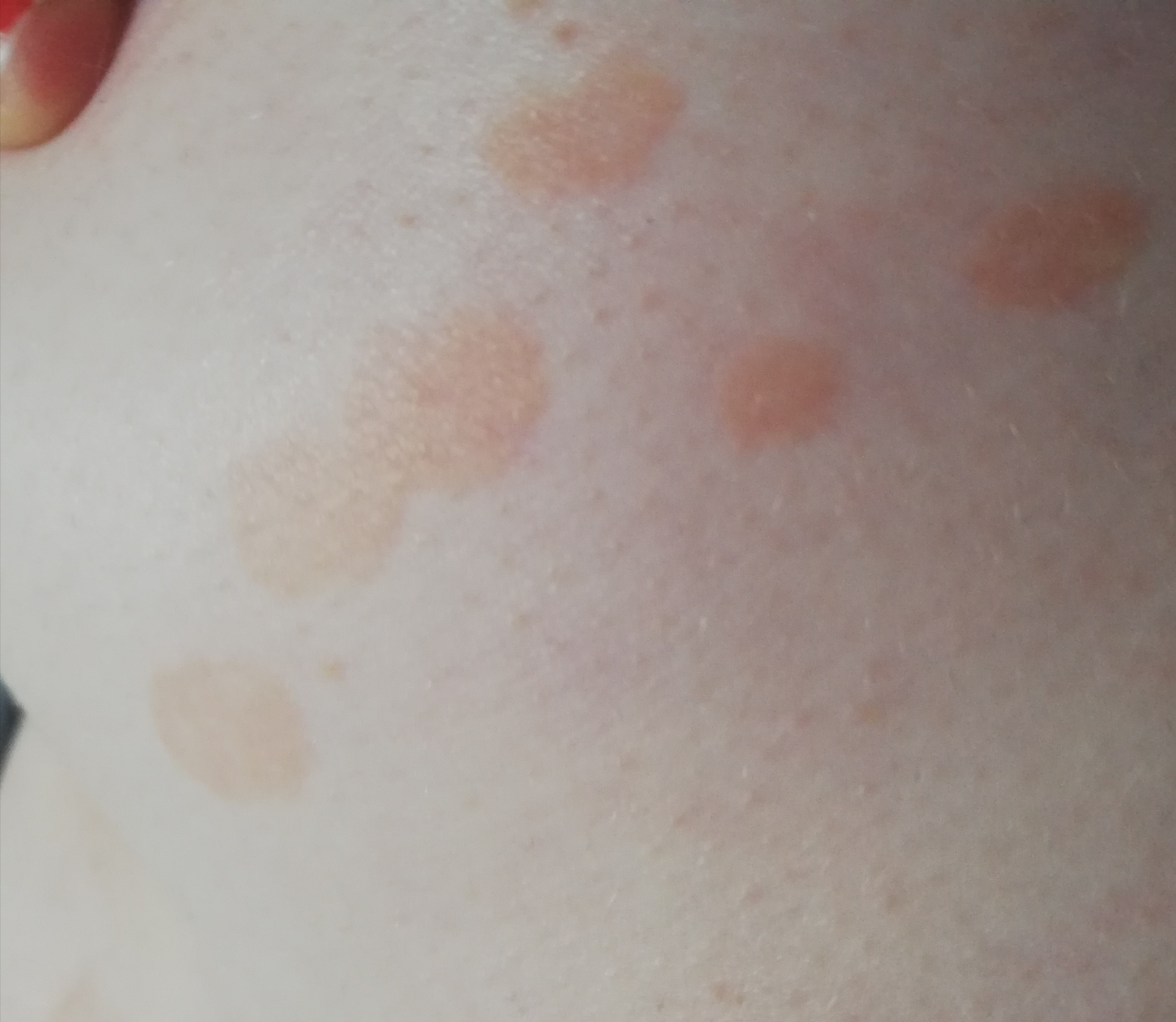 Was Sind Das Fur Komische Braune Flecken Gesundheit Und Medizin Gesundheit Medizin Was Sind Das Fur Komische Braune Flecken Gesundheit Und Medizin Gesundheit Medizin