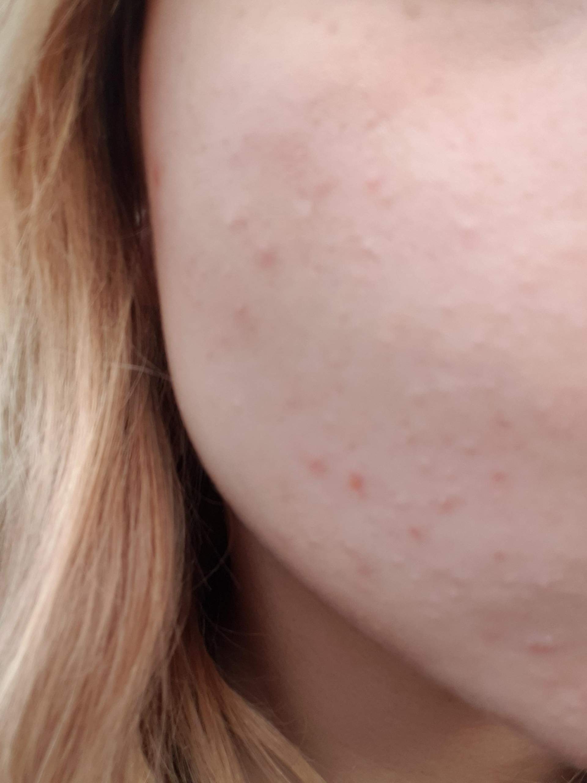 Was sind das für komische Pickel? (Gesundheit und Medizin, Beauty, Haut) pickel einnistung