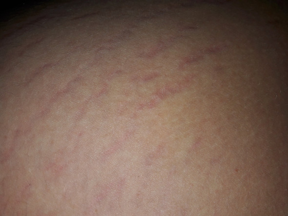 Was Sind Das Fur Lila Streifen An Mein Bein Arzt Hautarzt Krampfadern