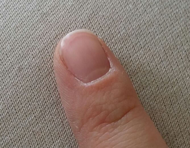 Was sind das für Linien? (Fingernagel) (Gesundheit, Gesundheit und ...