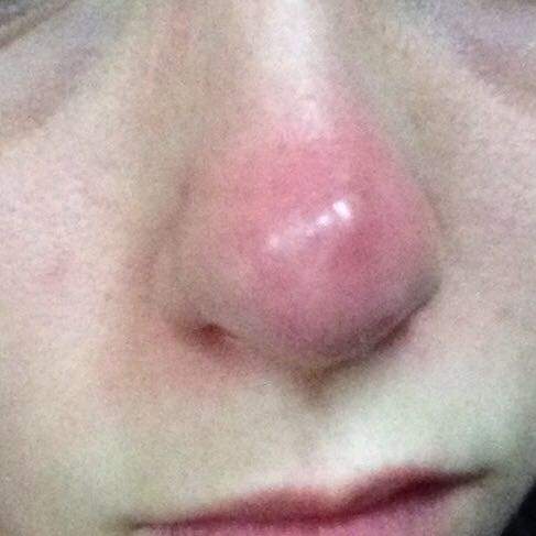 pickel in der nase ausdrücken pickel in der nase ausdrücken