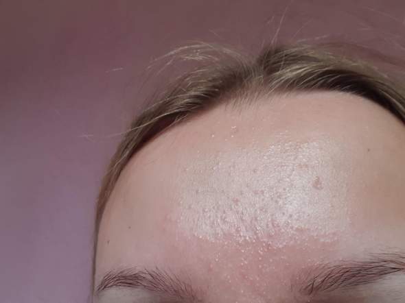 Was Sind Das Fur Pickel Gesundheit Und Medizin Haut