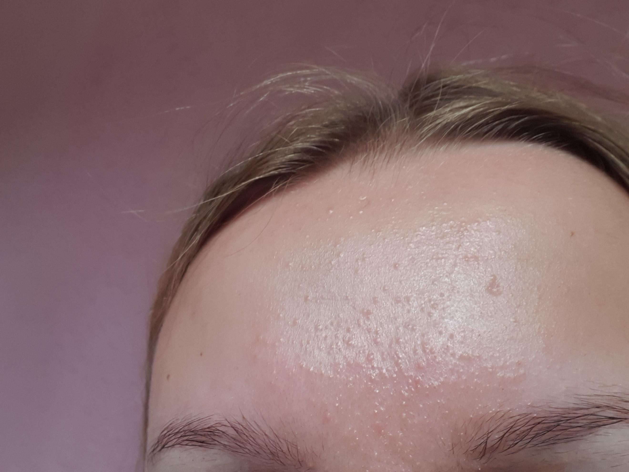 pickel haaransatz pickel haaransatz