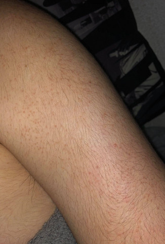 Was Sind Das Fur Pickel Am Arm Auf Dem Bild Gesundheit Und Medizin Gesundheit Medizin