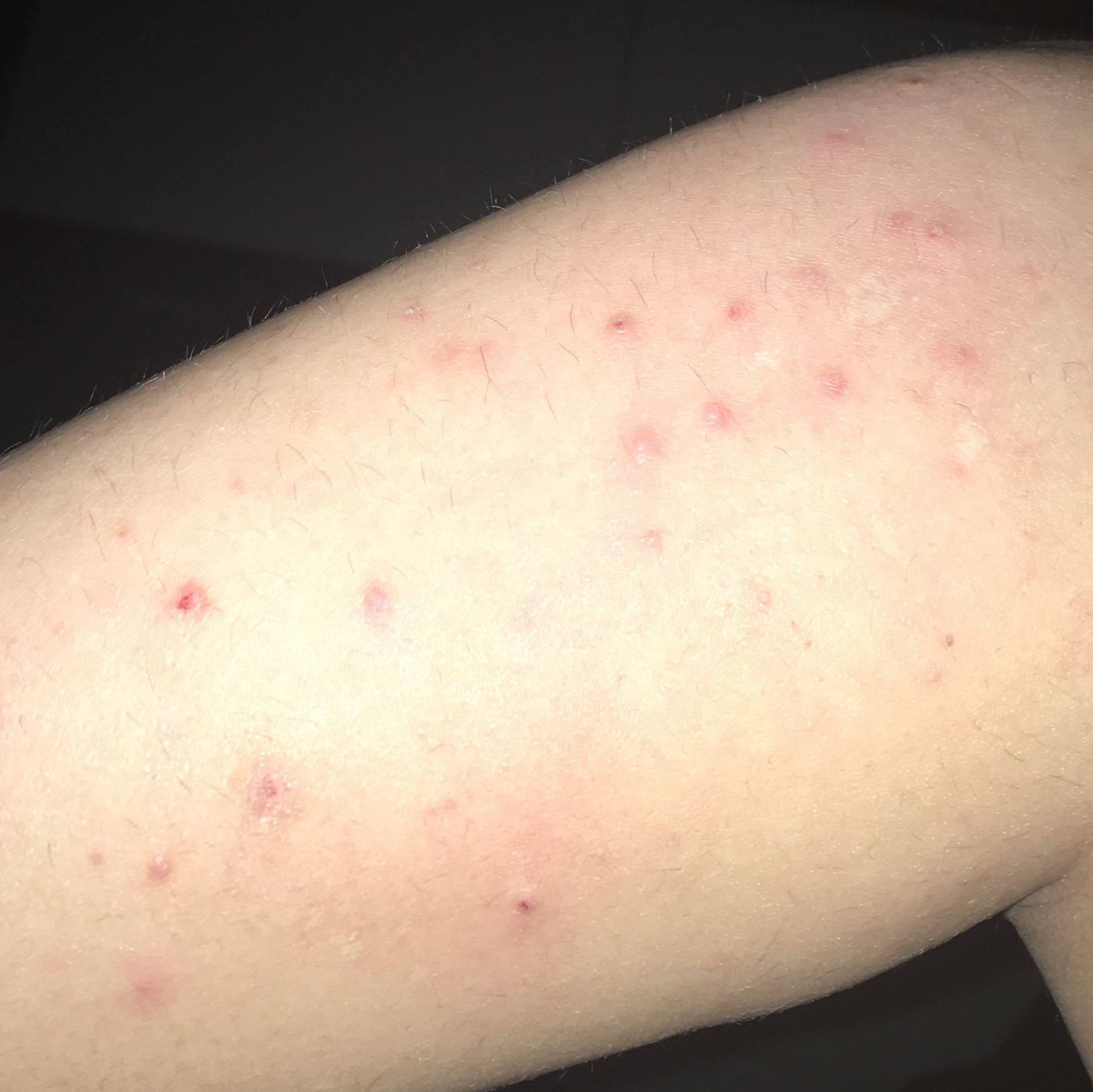 pickel auf dem oberarm pickel auf dem oberarm