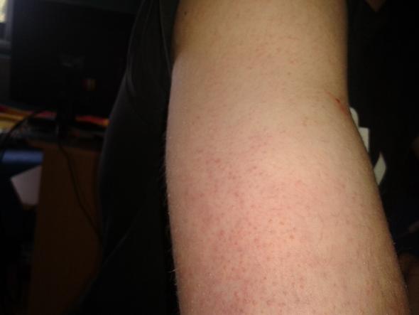 Was Sind Das Fur Pickel An Meinem Arm