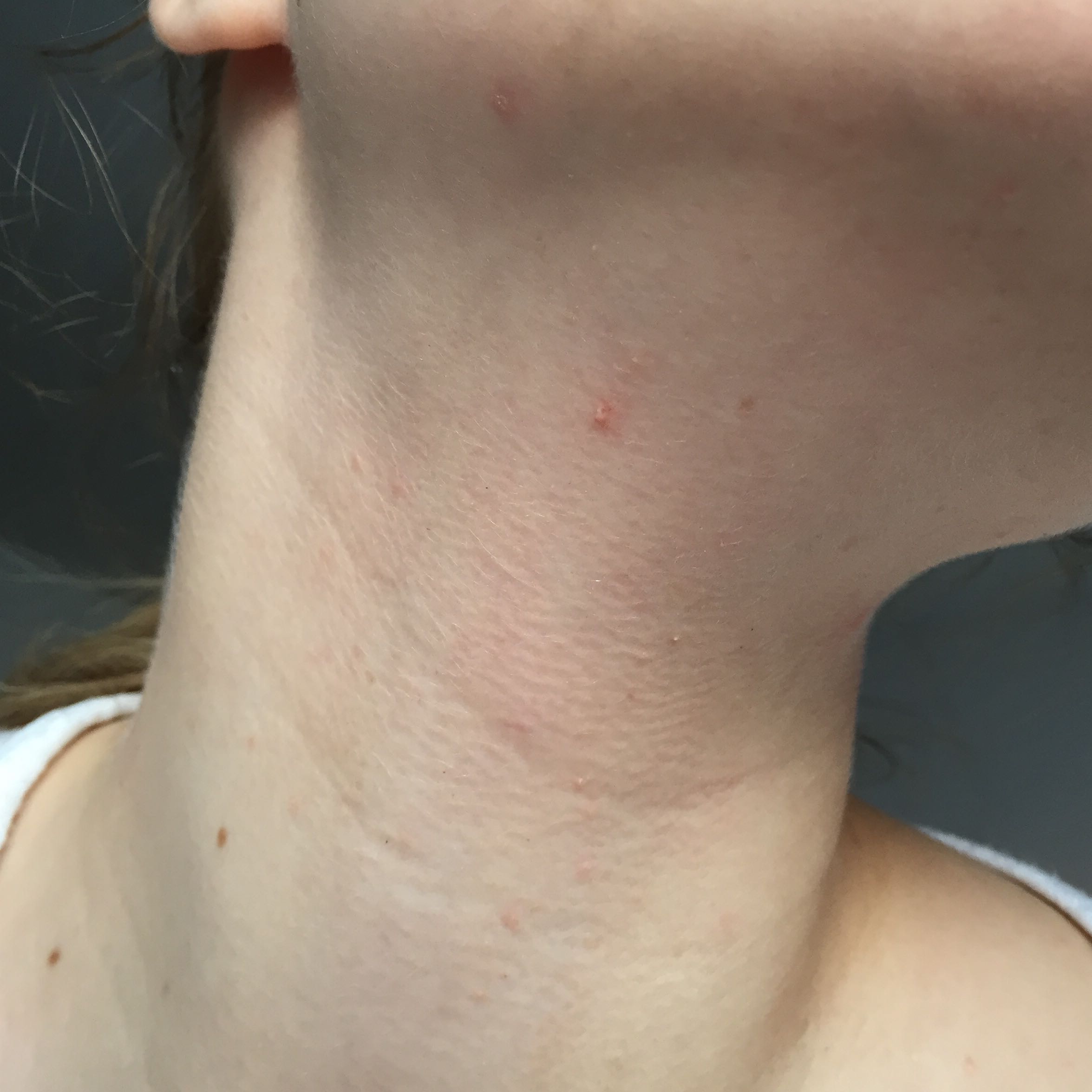 pickel am hals mit 40 pickel am hals mit 40