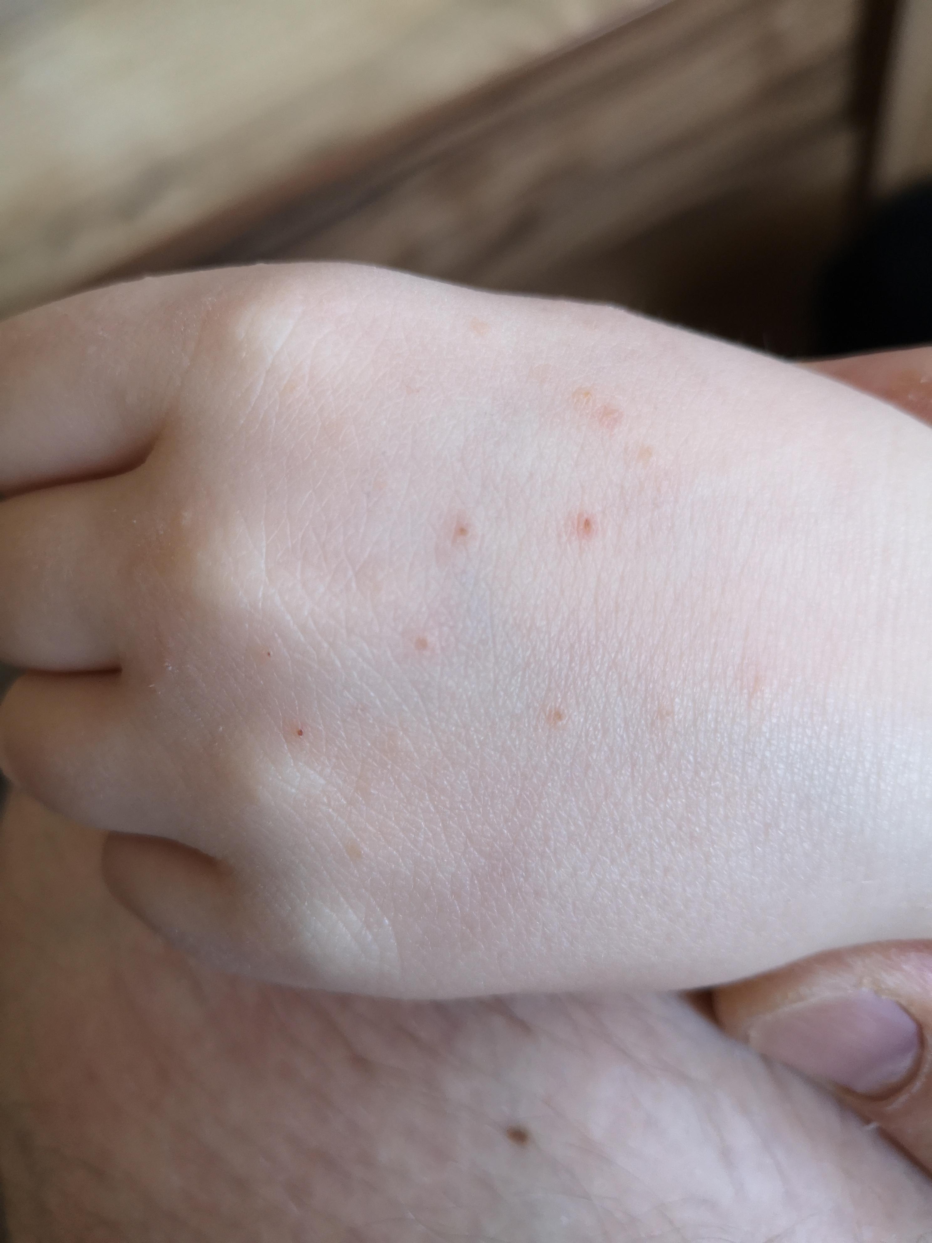 Was sind das für Pickel auf der Hand? (Gesundheit und Medizin