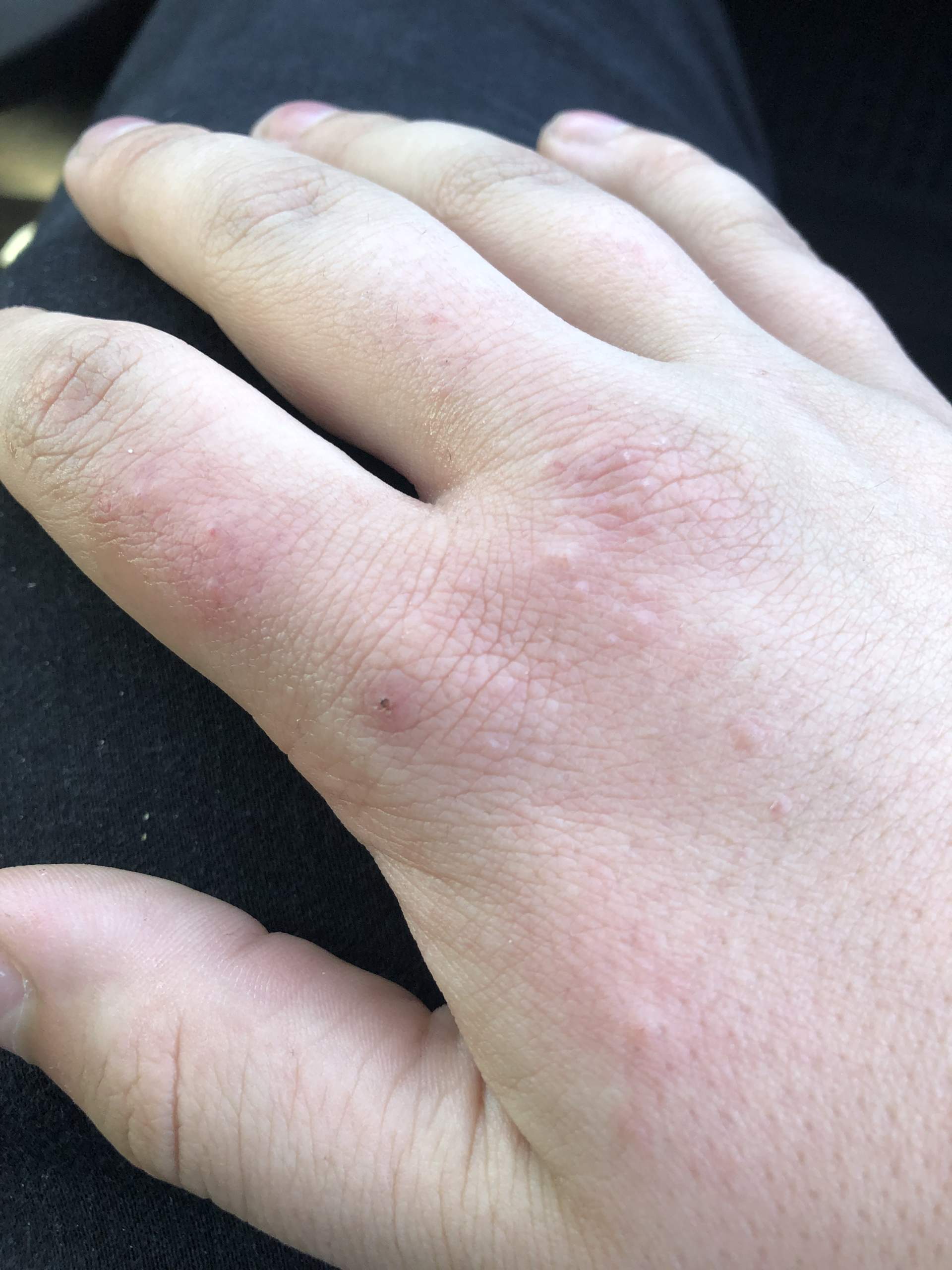 Hitzepickel An Der Hand Hitzepickel An Der Hand