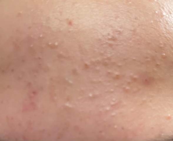 Was sind das für Pickel auf meiner Stirn? (Gesundheit und Medizin, Haut, Hautpflege) pickel auf der haut