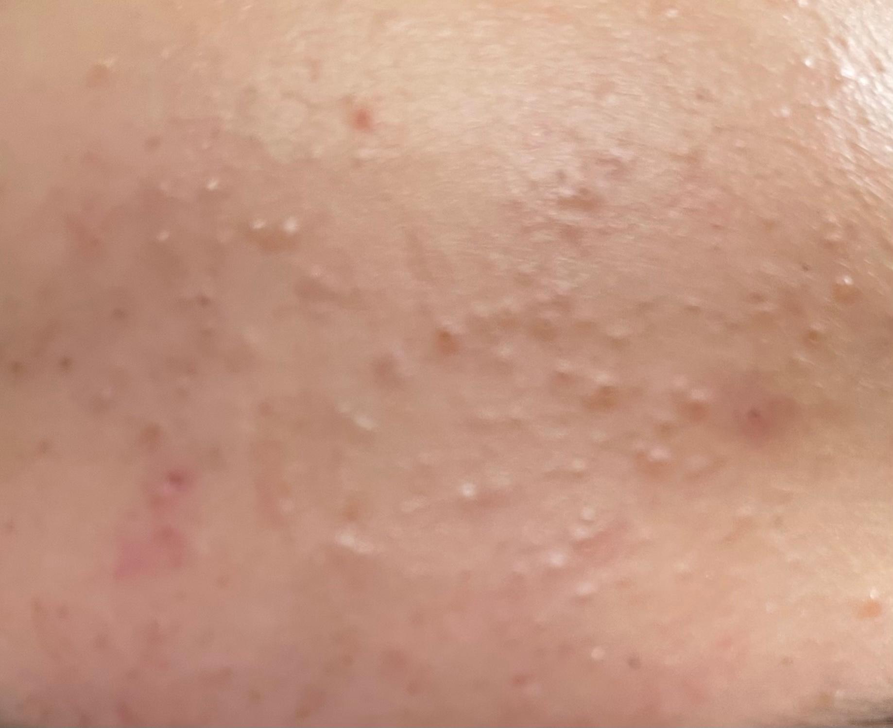 Was sind das für Pickel auf meiner Stirn? (Gesundheit und Medizin, Haut, Hautpflege) pickel an stirn