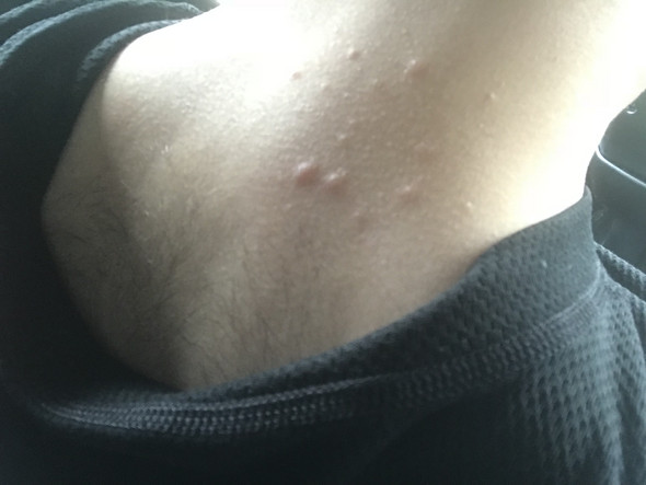 Was Sind Das Fur Pickel Im Nacken Was Sind Das Fur Pickel Im Nacken