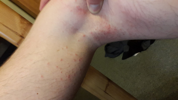 Was Sind Das Fur Pickel In Meiner Kniekehle Gesundheit Hautpflege Was Sind Das Fur Pickel In Meiner Kniekehle Gesundheit Hautpflege