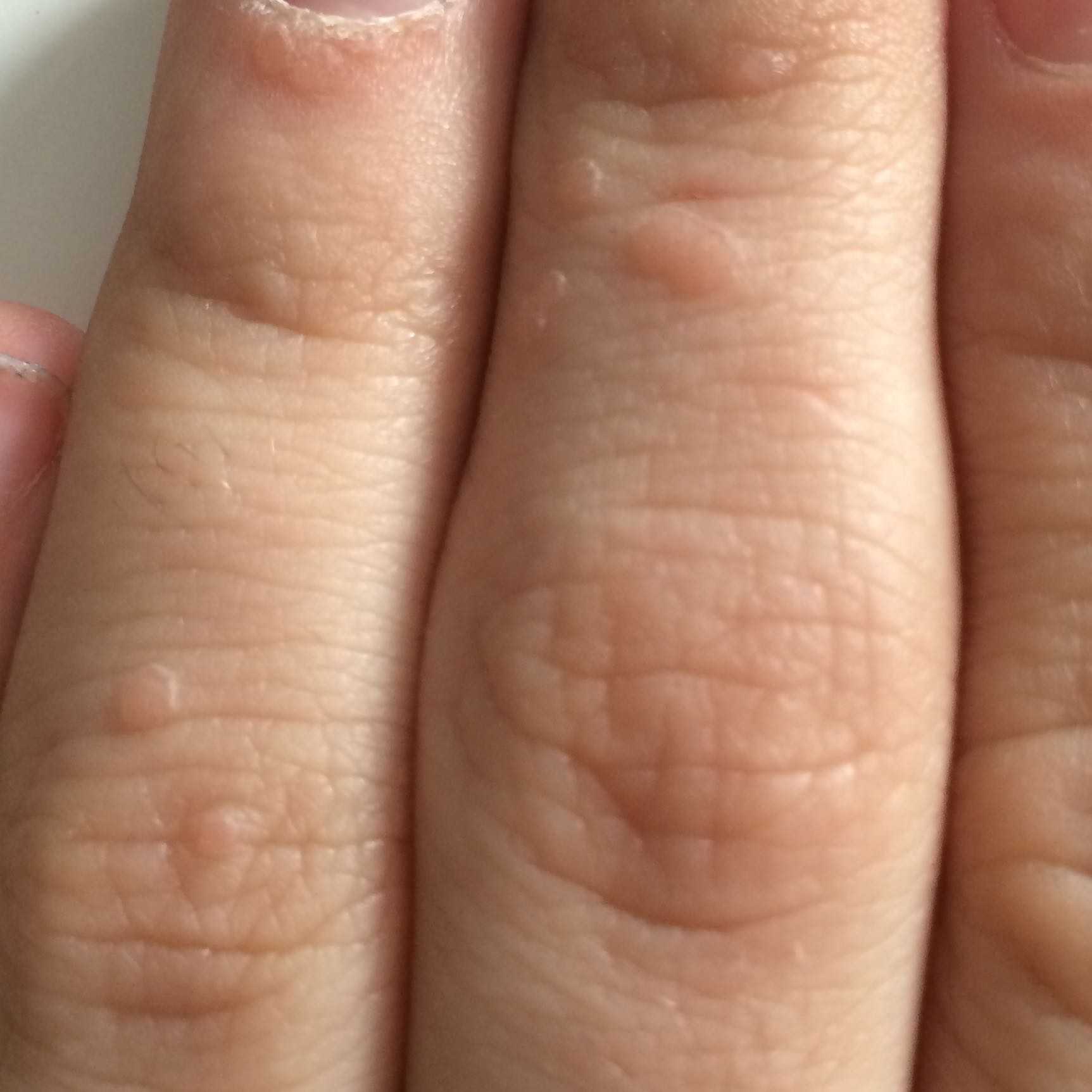 pickel an der hand pickel an der hand