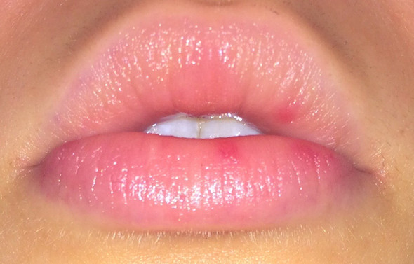 Was sind das für Pickel/Flecken auf meiner Lippe?