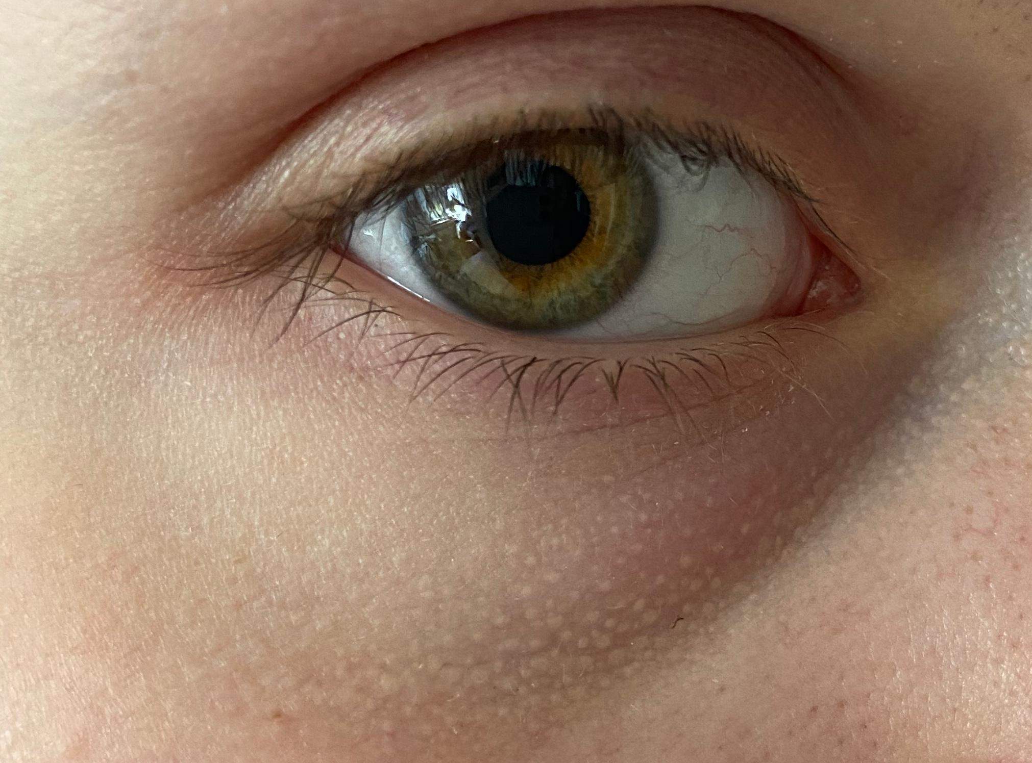 Was sind das für Punkte am Auge? (Gesundheit und Medizin, Gesundheit