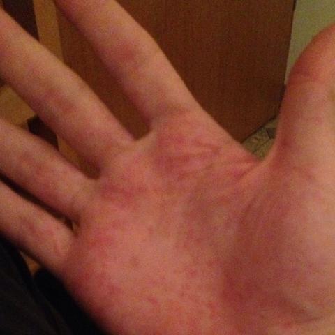 Was Sind Das Fur Punkte An Meiner Hand Arzt Ausschlag Was Sind Das Fur Punkte An Meiner Hand Arzt Ausschlag
