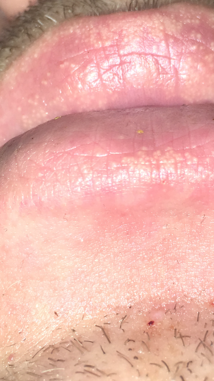 43+ Weisse punkte auf der lippe bilder , Was sind das für Punkte an meiner Lippe? (Gesundheit, Medizin)