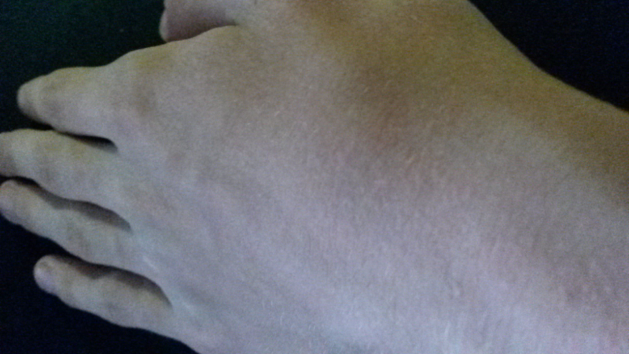 Was sind das für raue Pickel auf der Handoberfläche und teils auf den Unterarmen? (Hand, Arm) pickel auf der hand