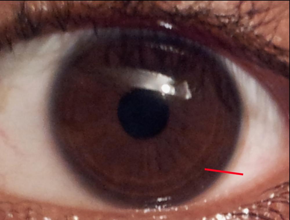 Was sind das für Ringe in meinem Augen? (Medizin, Menschen, Kopf)