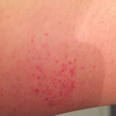 Was Sind Das Fur Rote Punkte Allergie Mucken Was Sind Das Fur Rote Punkte Allergie Mucken