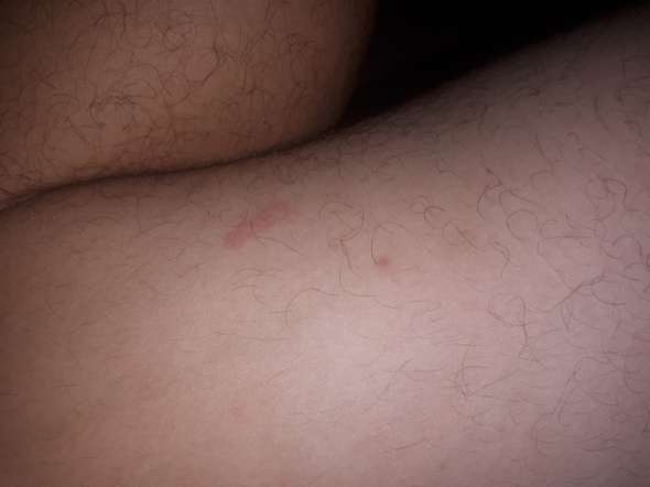 Was Sind Das Fur Rote Flecken Am Bein Gesundheit Medizin Korper Was Sind Das Fur Rote Flecken Am Bein Gesundheit Medizin Korper