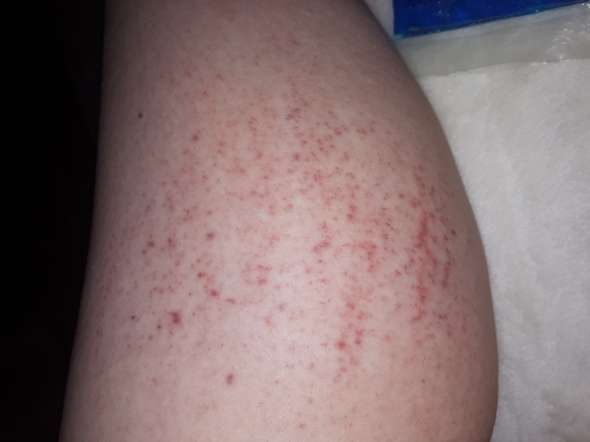 Was Sind Das Fur Rote Flecken Auf Meinem Bein Jucken Rote Flecken Haut Was Sind Das Fur Rote Flecken Auf Meinem Bein Jucken Rote Flecken Haut