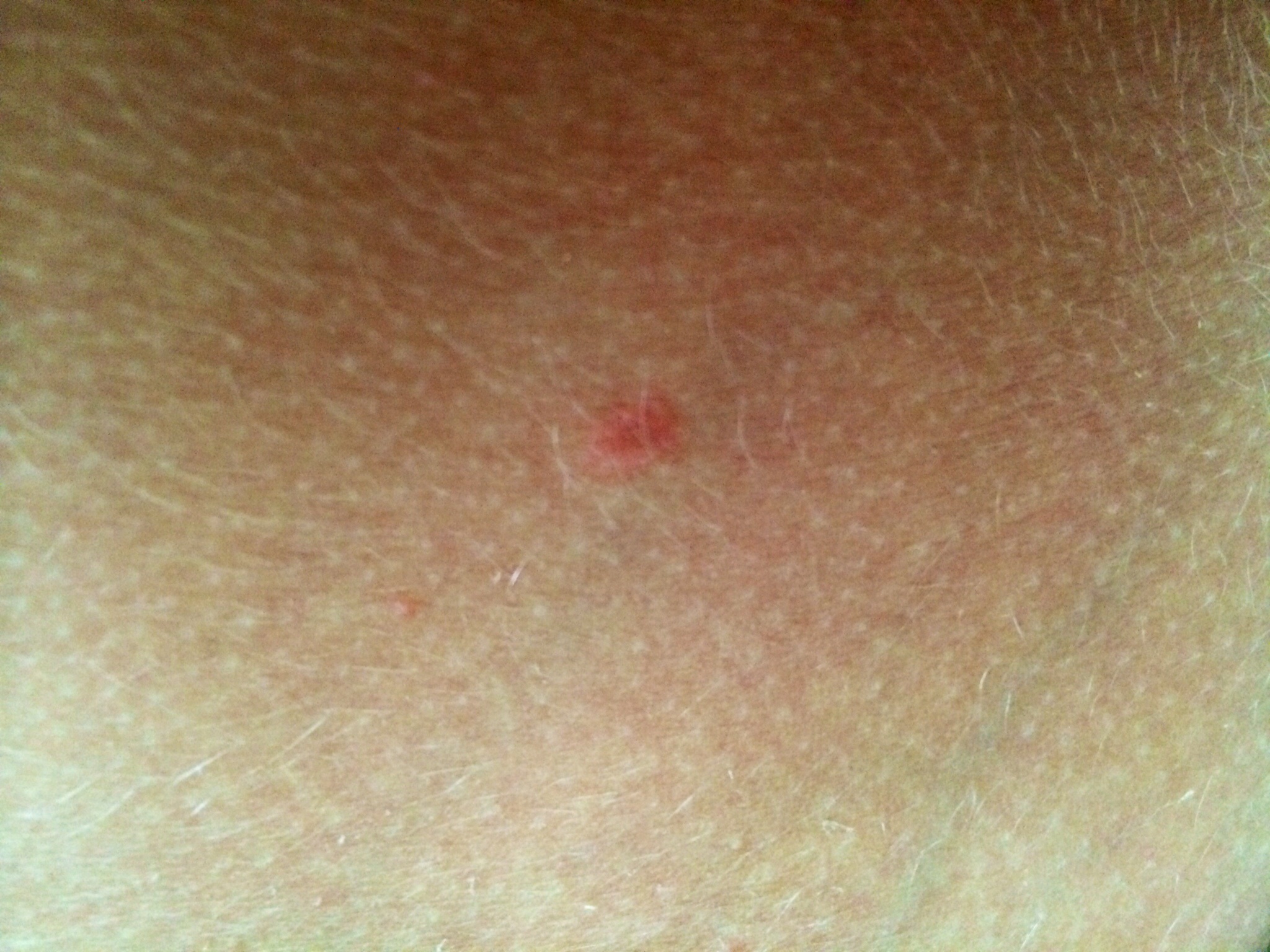 Rote Flecken Rote Flecken