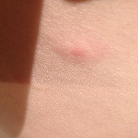 15+ Rote Flecken Nach Pickel Hausmittel Background