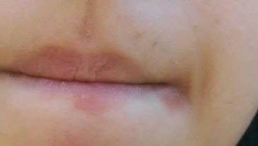 Was Sind Das Fur Rote Flecken Um Meinem Mund Rot Ausschlag Was Sind Das Fur Rote Flecken Um Meinem Mund Rot Ausschlag