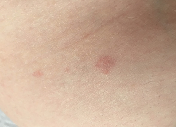 Was Sind Das Fur Rote Komische Flecken Auf Meiner Haut Arzt Hautarzt Ratschlag Was Sind Das Fur Rote Komische Flecken Auf Meiner Haut Arzt Hautarzt Ratschlag