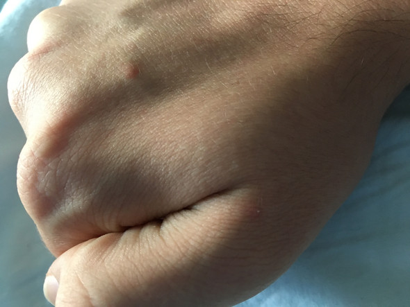 Rötungen am Handrücken - (Gesundheit und Medizin, Angst, Haut)