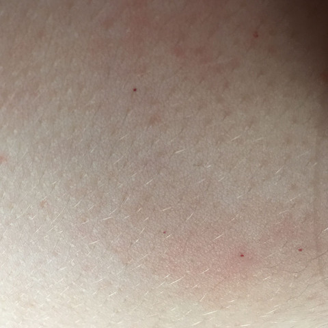 Was Sind Das Fur Rote Punkte Auf Der Brust Haut Rote Punkte Was Sind Das Fur Rote Punkte Auf Der Brust Haut Rote Punkte