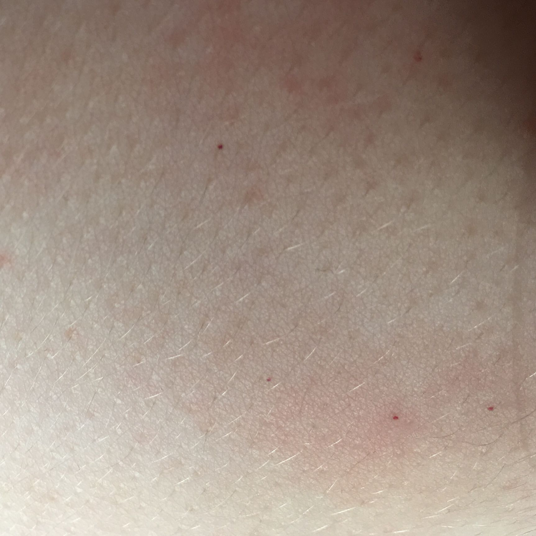 Was sind das für rote Punkte auf der Brust? (Haut, rote-punkte)