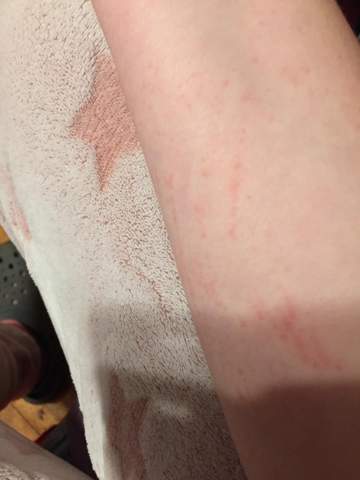 Was sind das für rote Punkte auf meinem Arm?(Ungefähr seit 2 Wochen)?