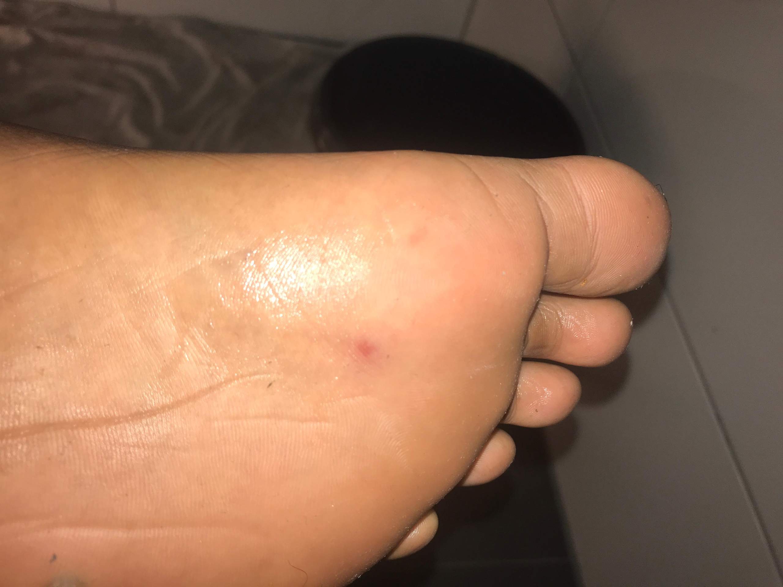 Was sind das für rote punkte auf meinem fuß und warum tun meine Nerven ...