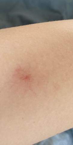 Was Sind Das Fur Rote Punkte Auf Meiner Haut Gesundheit Und Medizin Hautprobleme Rote Punkte Was Sind Das Fur Rote Punkte Auf Meiner Haut Gesundheit Und Medizin Hautprobleme Rote Punkte