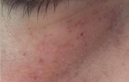 Q10 koensim die Masken für die Haut um die Augen