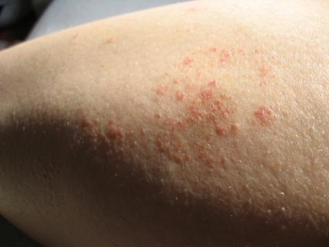 Was Sind Das Fur Rote Pustelige Flecken Am Bein Gesundheit Ausschlag Hautkrankheit Was Sind Das Fur Rote Pustelige Flecken Am Bein Gesundheit Ausschlag Hautkrankheit