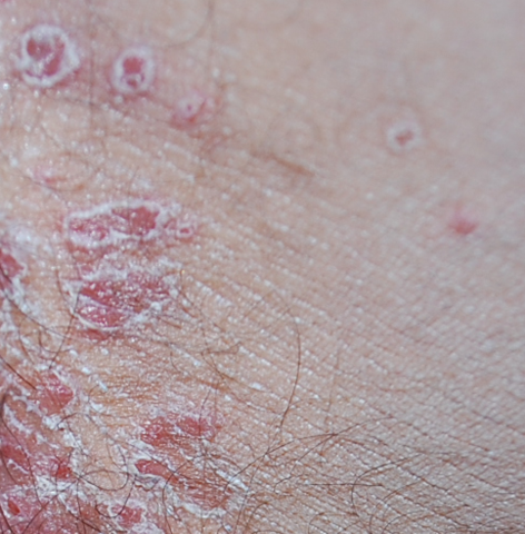 47+ Rote Pickel Flecken Wegbekommen PNG