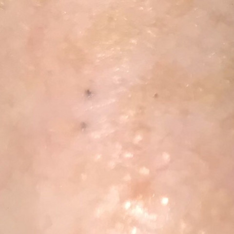 Was Sind Das Fur Schwarze Punkte Auf Dem Nasenrucken Schwarz Was Sind Das Fur Schwarze Punkte Auf Dem Nasenrucken Schwarz