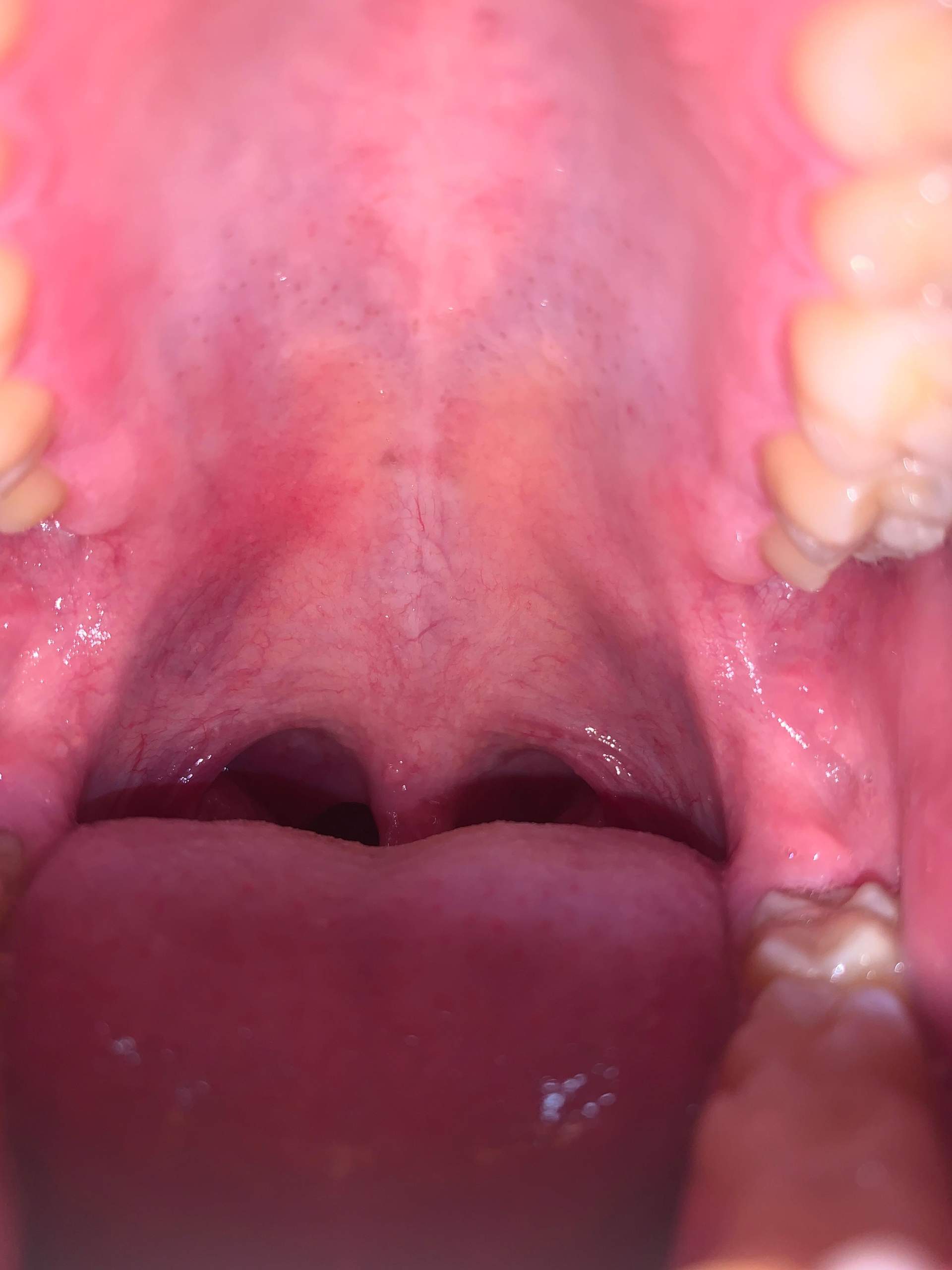 Was sind das für Schwarze Punkte im Mund? (Gesundheit und Medizin, Gesundheit)