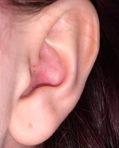 Was sind das für schwarze Punkte/Löcher in meinem Ohr?