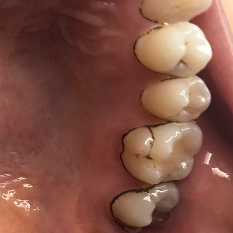 Was Sind Das Fur Schwarze Rander An Meinen Zahnen Gesundheit Und Medizin Zahne Zahnbehandlung