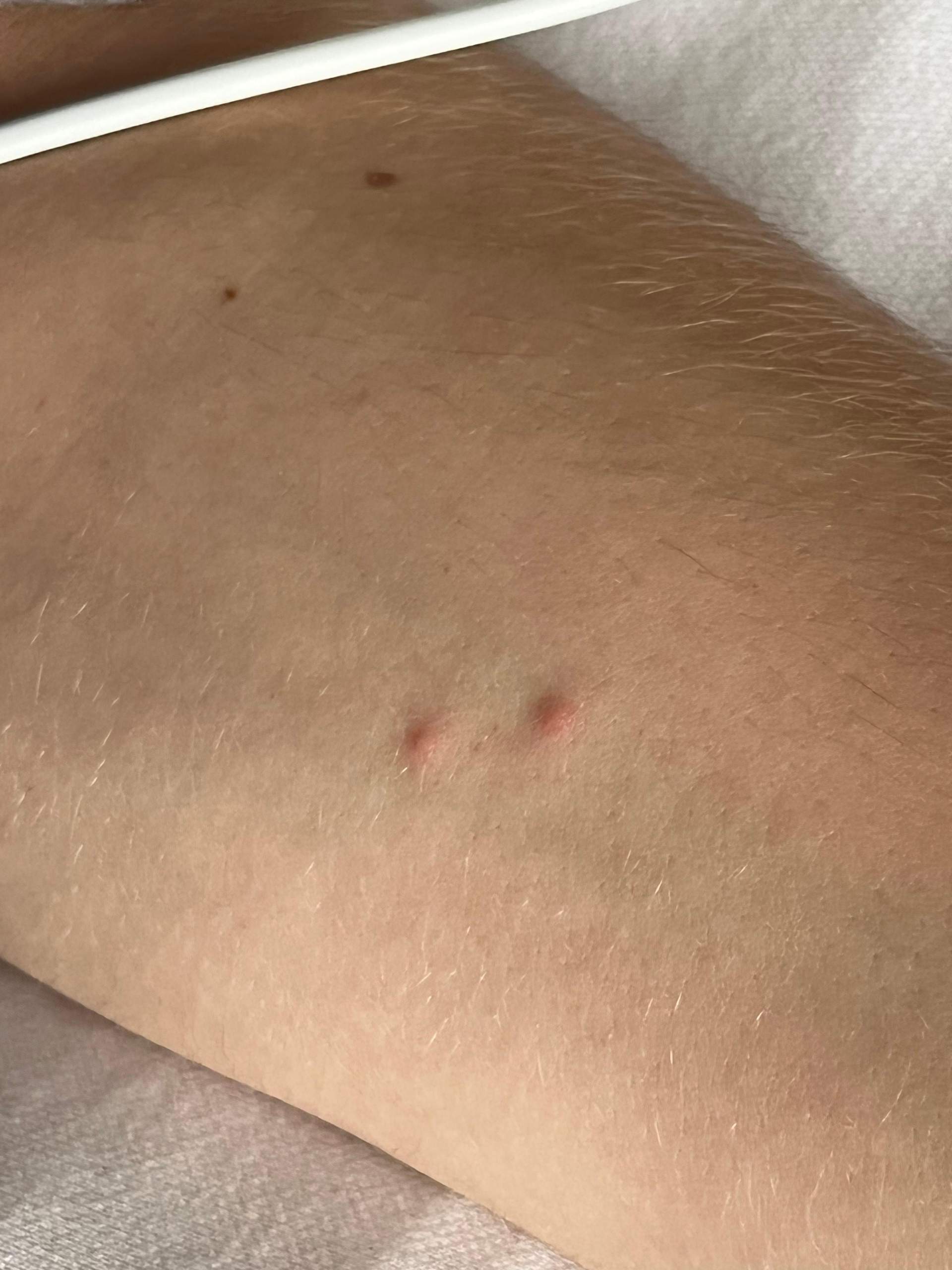 Kleine Stiche Am Krper